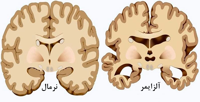 تفاوت مغز فرد سالم و فرد مبتلا به الزایمر