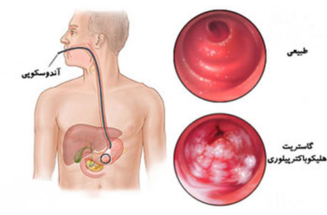 تشخیص ورم معده با آندوسکوپی