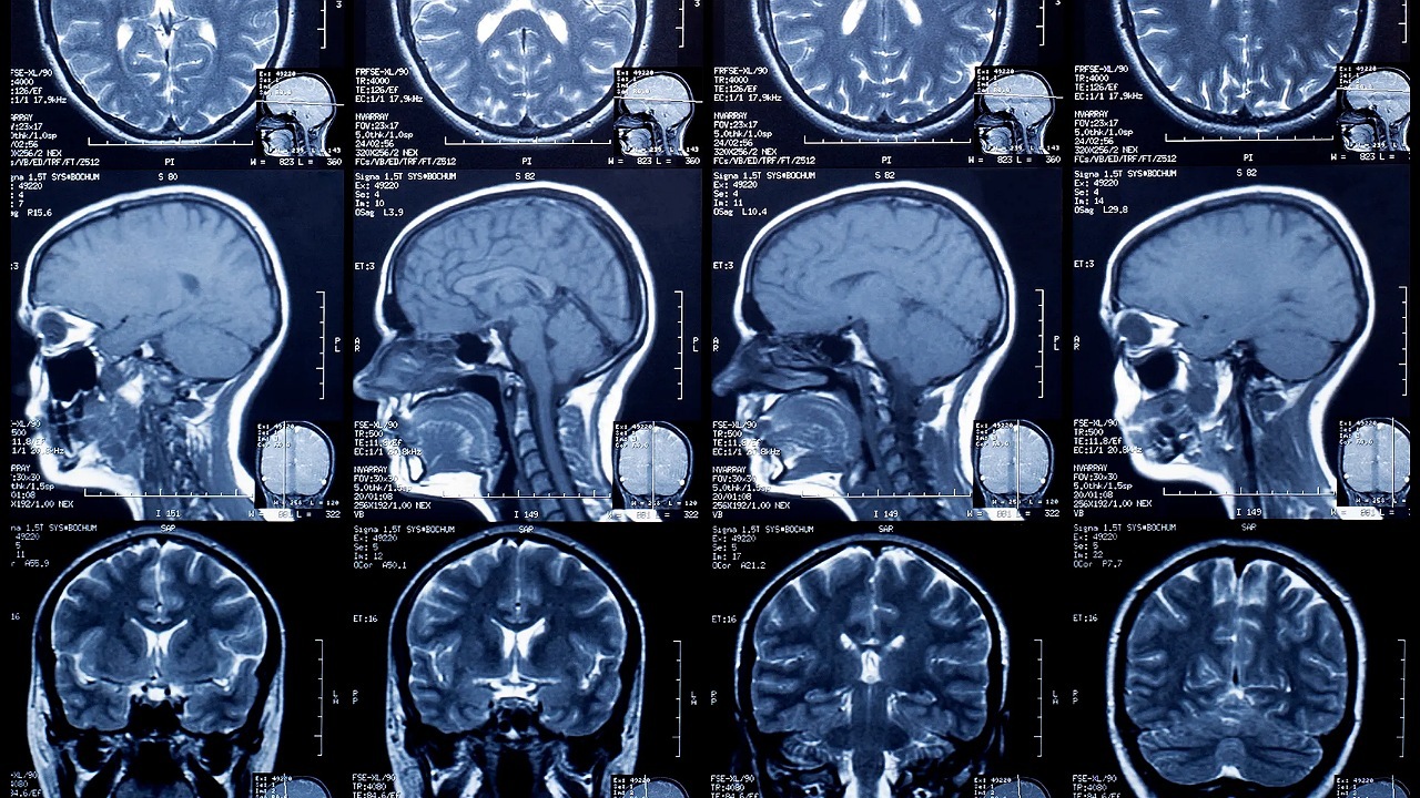 تصویربرداری از مغز برای تشخیص آلزایمر - MRI مغز