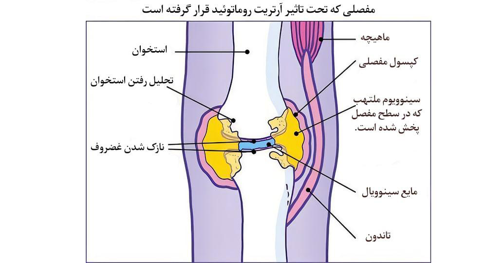 عوارض روماتوئید