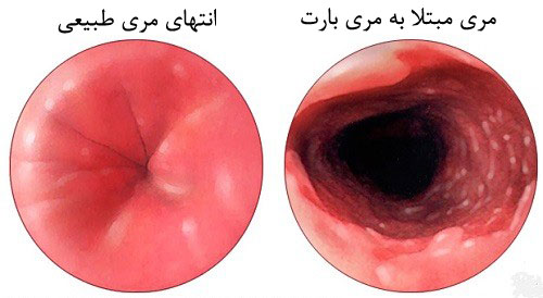 رفلاکس معده و مری بارت