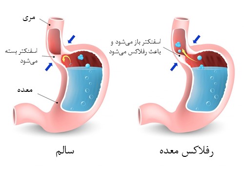 رفلاکس اسید معده