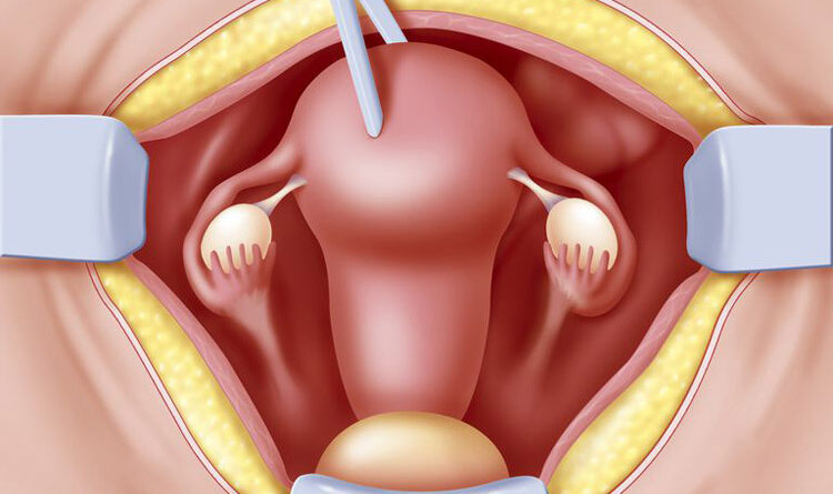 An abdominal hysterectomy