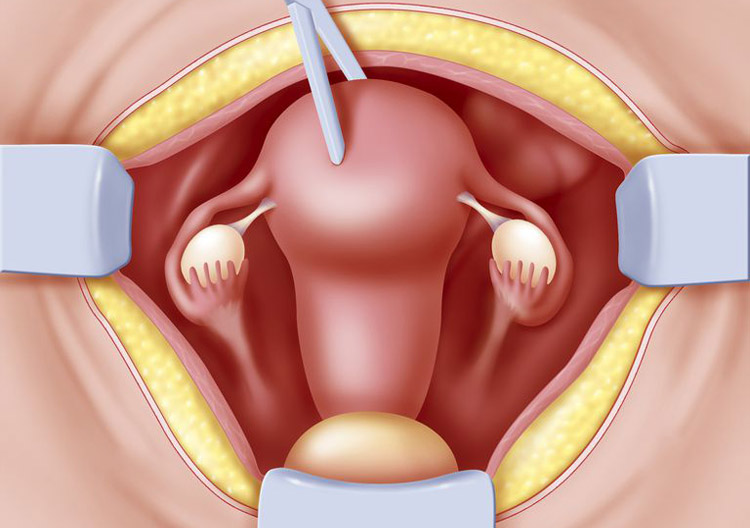 An abdominal hysterectomy