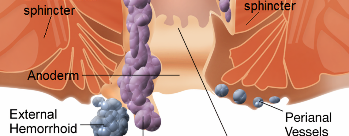 Internal_and_external_hemorrhoids