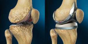 Knee Replacement