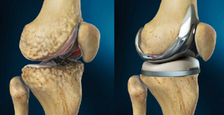 Knee Replacement