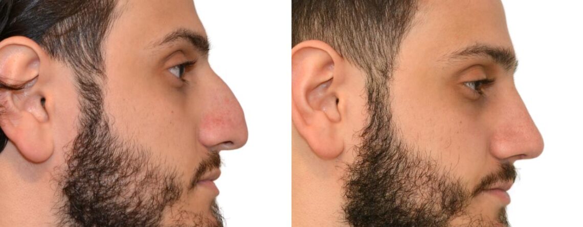 Rhinoplasty