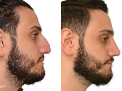 Rhinoplasty