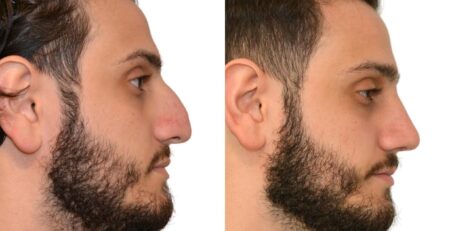 Rhinoplasty