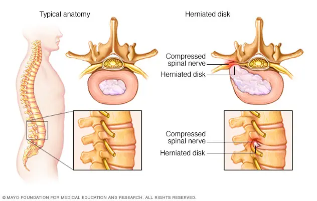 herniated disk