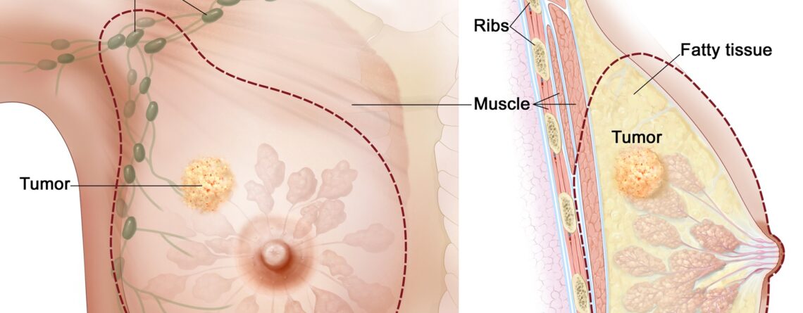 Mastectomy