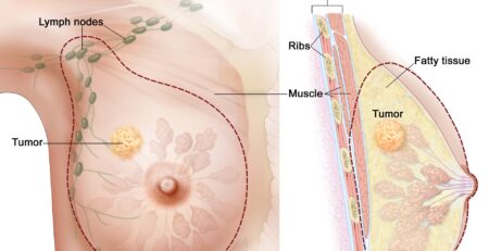 Mastectomy