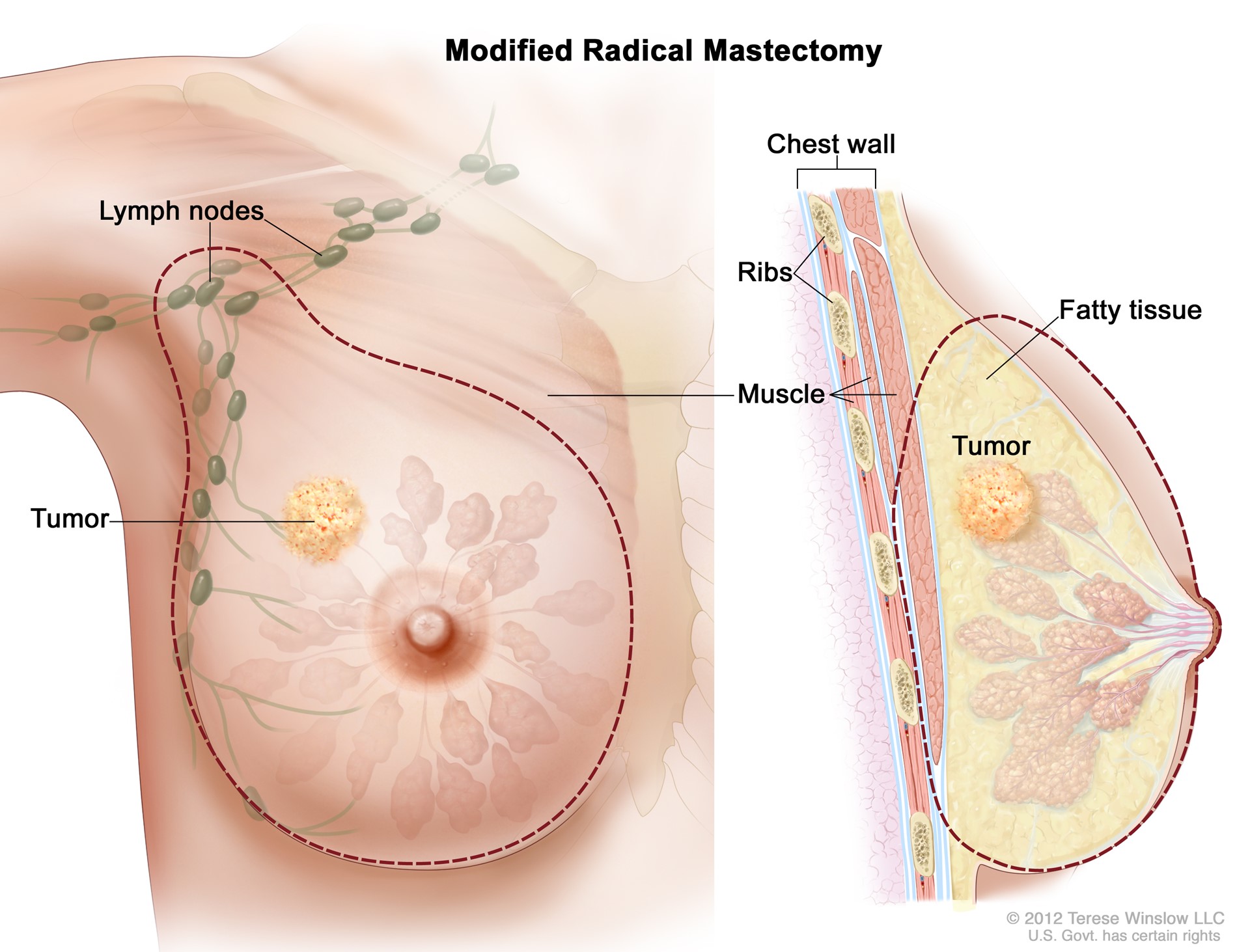 Mastectomy