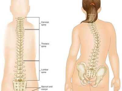 Scoliosis