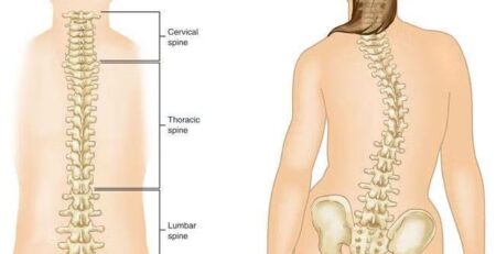 Scoliosis