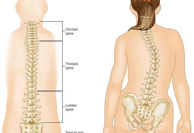 Scoliosis