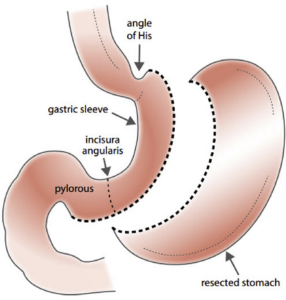 Sleeve gastrectomy