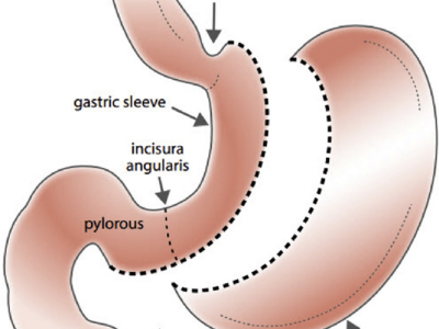 Sleeve gastrectomy