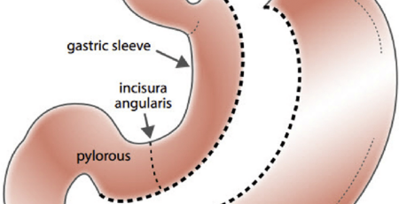 Sleeve gastrectomy