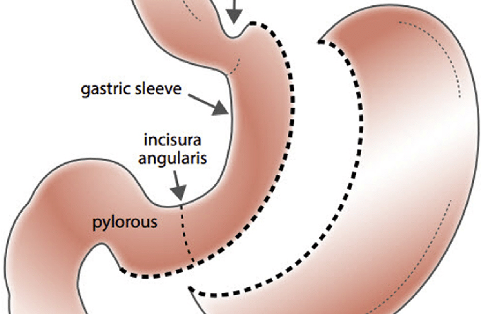 Sleeve gastrectomy