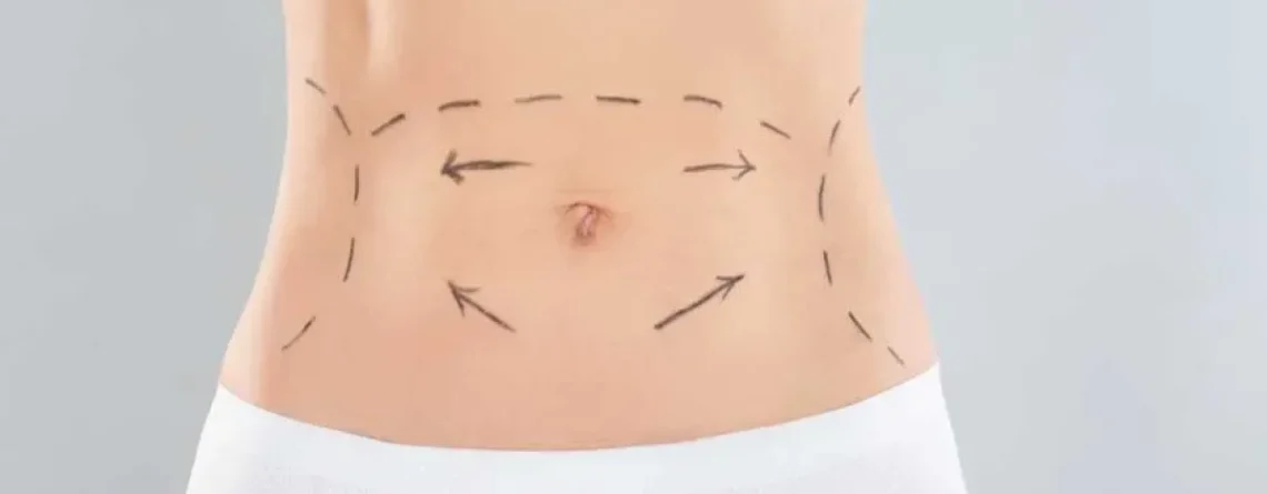 Tummy tuck