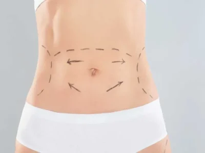 Tummy tuck