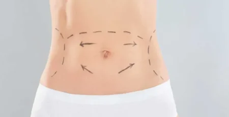 Tummy tuck