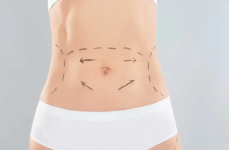 Tummy tuck